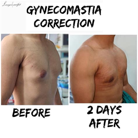 gynecomastia melbourne fl|Best Gynecomastia Doctors in Melbourne, FL .